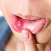 Mouth ulcers (3)